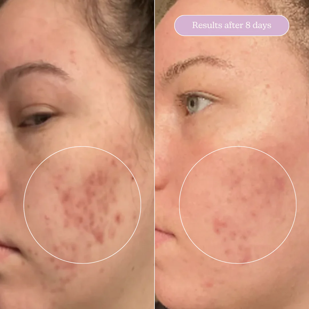Acne Treat & Fade Bundle - Image 11