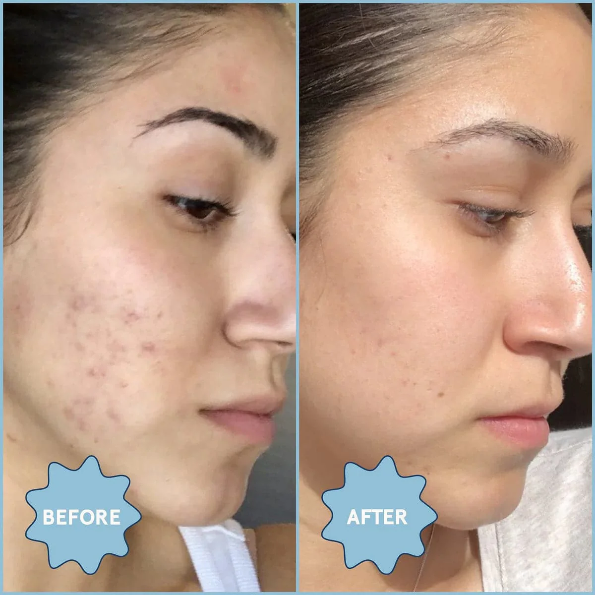 Clear Skin Kit: Acne Essentials - Image 12