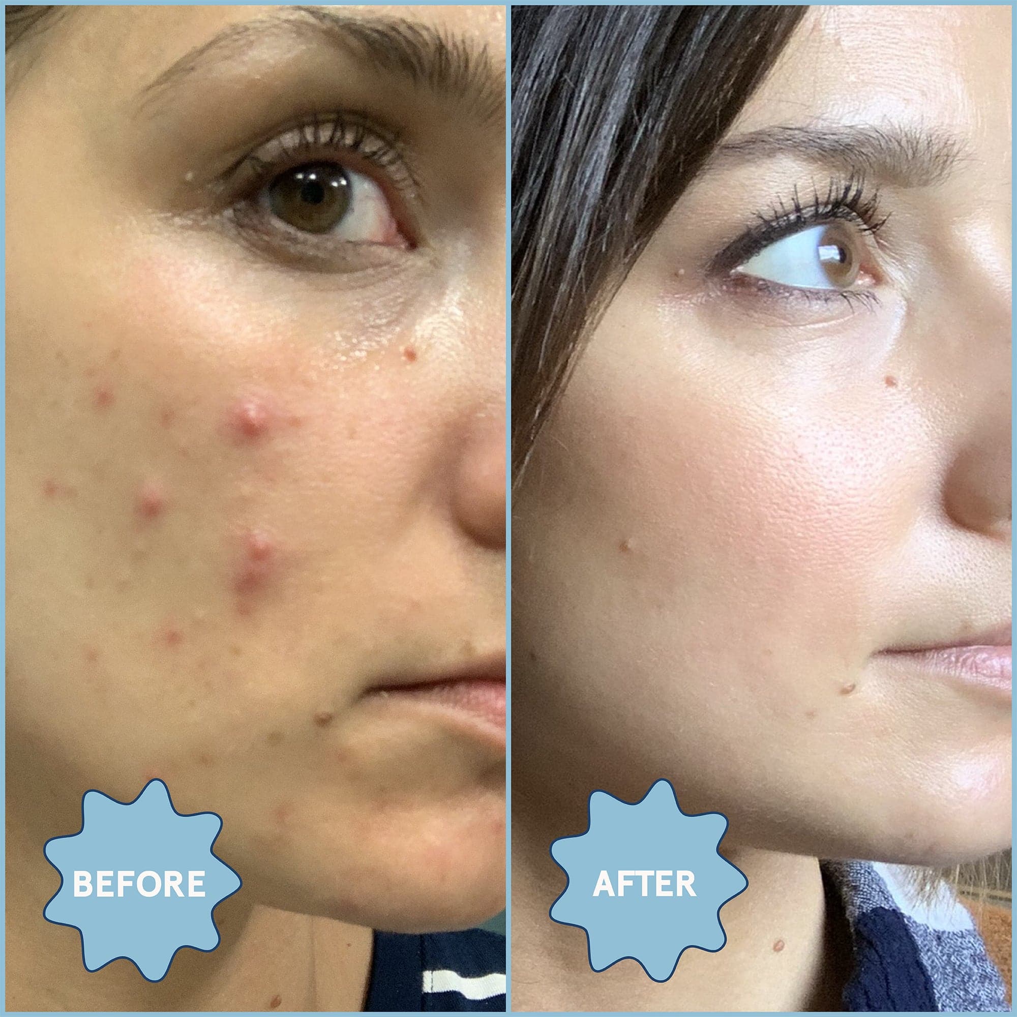 Clear Skin Kit: Acne Essentials - Image 13